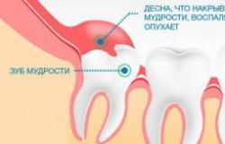 Причини зростання кривих зубів