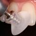 Шокуюча інформація: чому після брекетів зуби роз'їхалися та стали кривими?