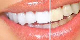 รอยยิ้มขาว - การฟอกสีฟันเป็นอันตรายหรือไม่?
