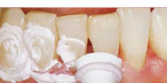 Профессиональное отбеливание зубов: виды и цены