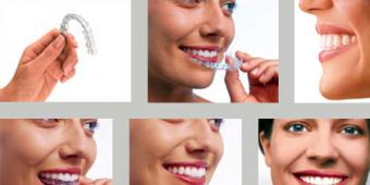 Скільки коштує відбілювання зубів у стоматології
