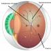 The effect of diabetes on vision: drops and vitamins for the eyes Diabetes and vision