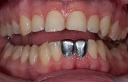 Штампованные коронки — средство защиты здоровых зубов Плюсы штампованных коронок
