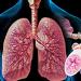 Ambrobene inhalatsioonilahus: kasutusjuhend Ambrobene tilkade kasutusjuhend täiskasvanutele
