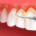 Чистка зубов ультразвуком — отзывы, до и после