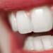 เป็นไปได้ไหมที่จะฟอกสีฟันที่ตายแล้วหรือฟันที่มีการอุดฟัน