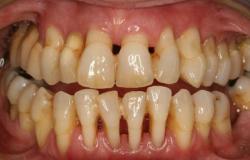 Парадонтоз: как спасти зубы и какие лекарства помогают Пародонтоз выпадение зубов