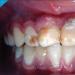 Некаріозні ураження зубів